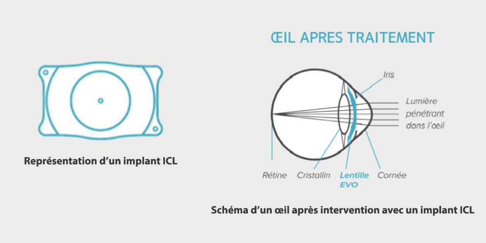 implant intra-oculaires phaques