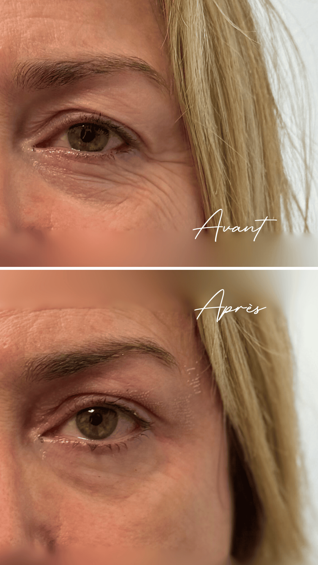 Avant/après blépharoplastie