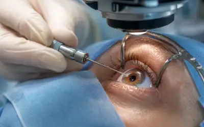 Quelle différence entre lasik, smile et transpkr lorsque la cornée est fine ?